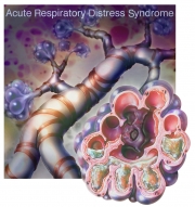 Acute Respiratory Distress Syndrome