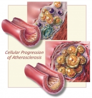 Progression of Atherosclerosis