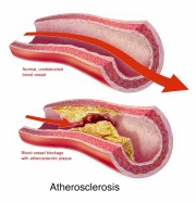 Atherosclerosis