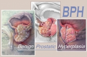 Benign Prostatic Hyperplasia