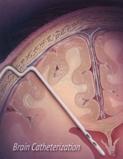 Brain Catheterization