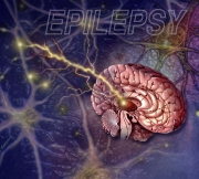 Epilepsy