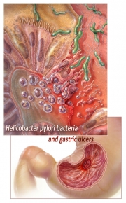 Gastric Ulcer