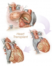 Heart Transplant