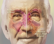 Infected Sinuses