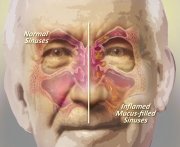 Infected Sinuses
