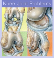 Knee Joint Problems