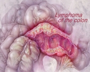Lymphoma of the Colon