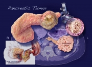 Pancreatic Tumor