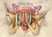Pelvic Sling