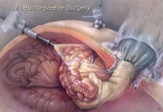 Pneumo-sleeve Surgery