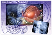 Splenic Artery Aneurysm