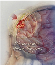 Traumatic Brain Injury