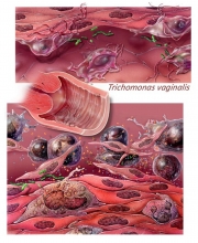 Trichomonas vaginalis