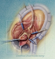 Urethral Diverticulectomy Surgery