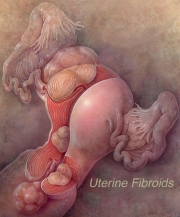 Uterine Fibroids