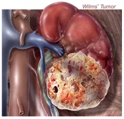 Wilms'Tumor
